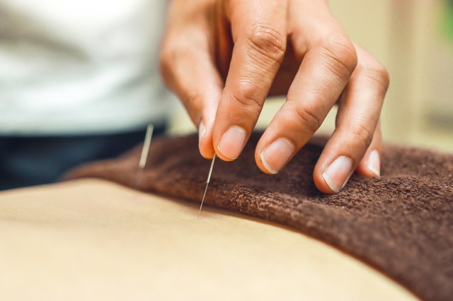 acupuncture needles going into a back