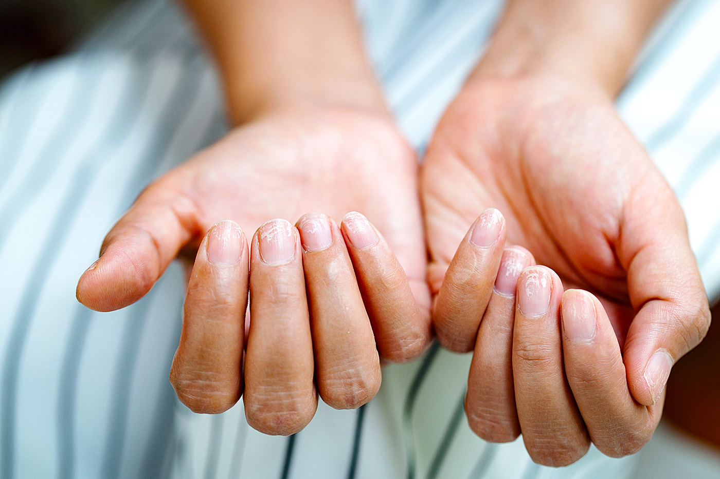 rittle damaged nails after using shellac or gel-lacquer