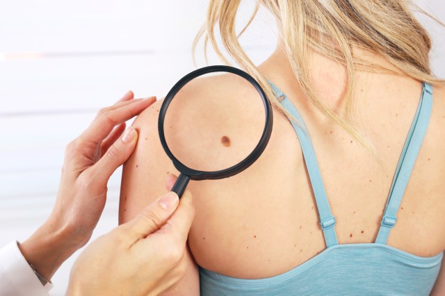 Doctor dermatologist examines birthmark of patient. Checking benign moles. 