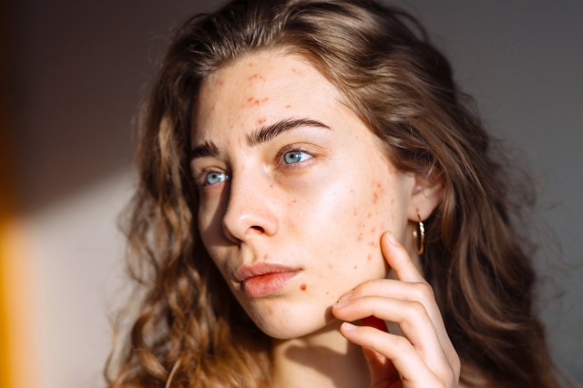 Young Woman with problem skin, breakouts, acne