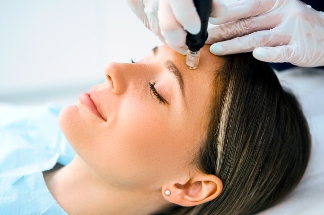 Skin needling treatment